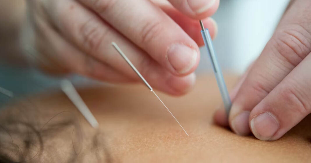 Si vous cherchez une alternative naturelle pour soigner le mal de tête, testez l'acupuncture