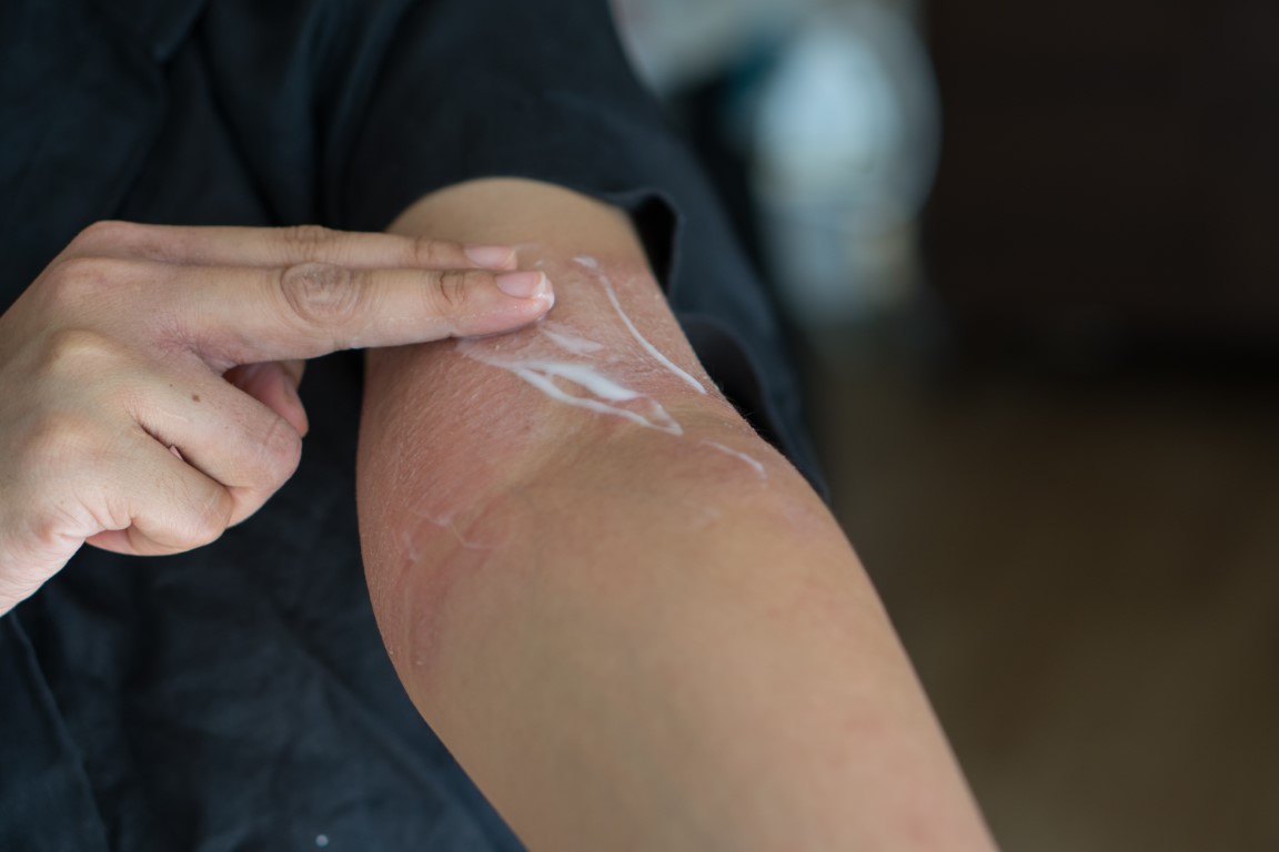 Traitement des boutons de stress avec de la crème