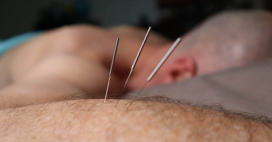 L'acupuncture recommandée par deux grands organismes de lutte contre le cancer