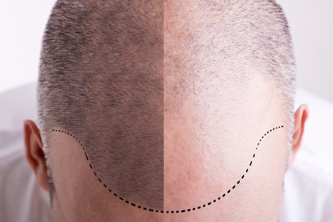 pourquoi réaliser greffe de cheveux