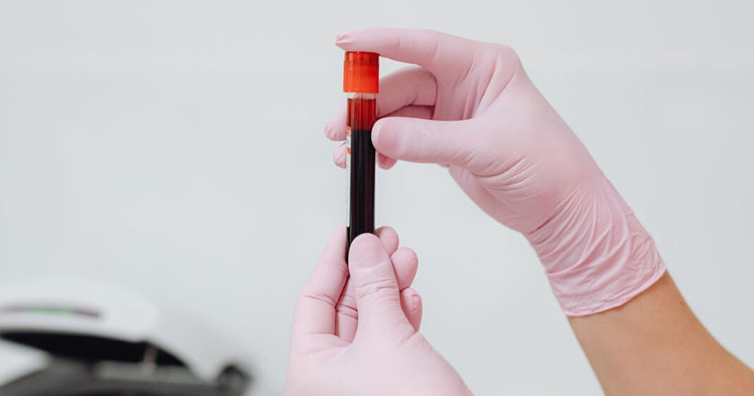 Un test sanguin pour détecter un Alzheimer précoce