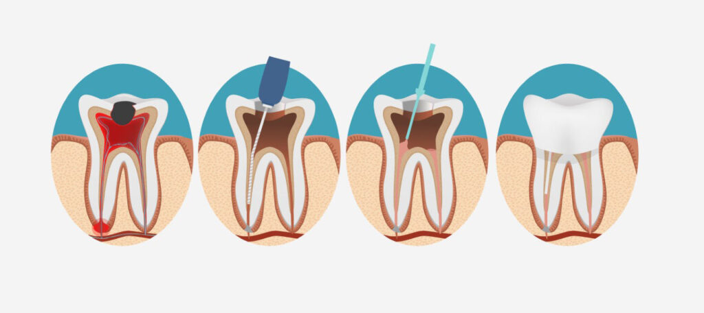 Le processus de dévitalisation d'une dent