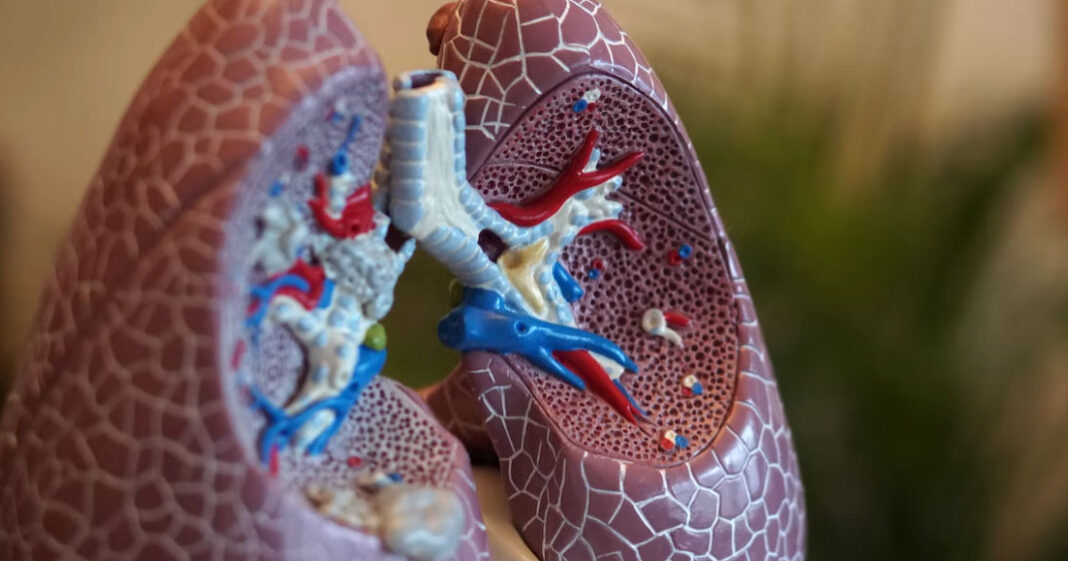 Il pourrait être possible de prédire l'apparition du cancer des poumons