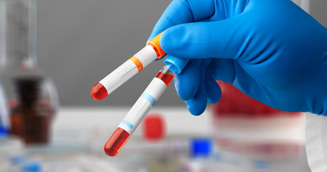 Un simple test sanguin peut déterminer si le cancer colorectal est soigné
