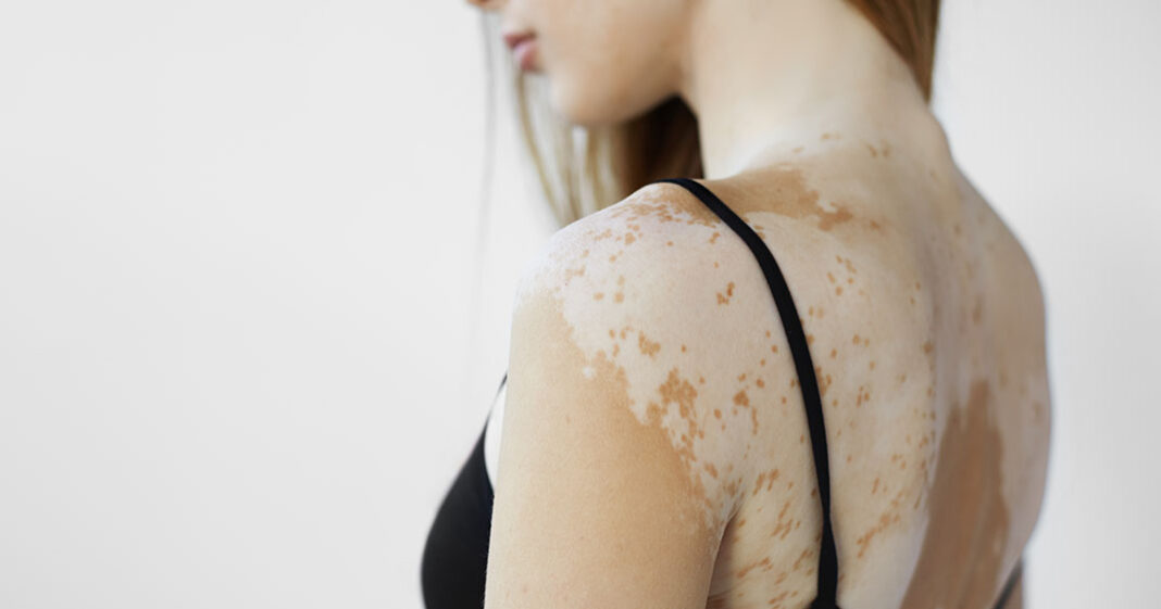 Le traitemebt contre le Vitiligo sera commercialisé en France courant 2024
