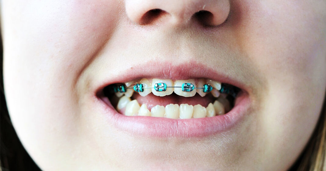 Un premier rendez-vous d'orthodontie est gratuit cette semaine pour les enfants