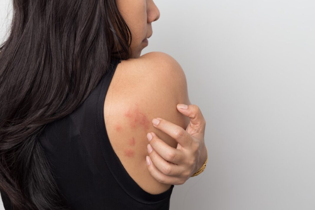Femme subissant une crise d'urticaire