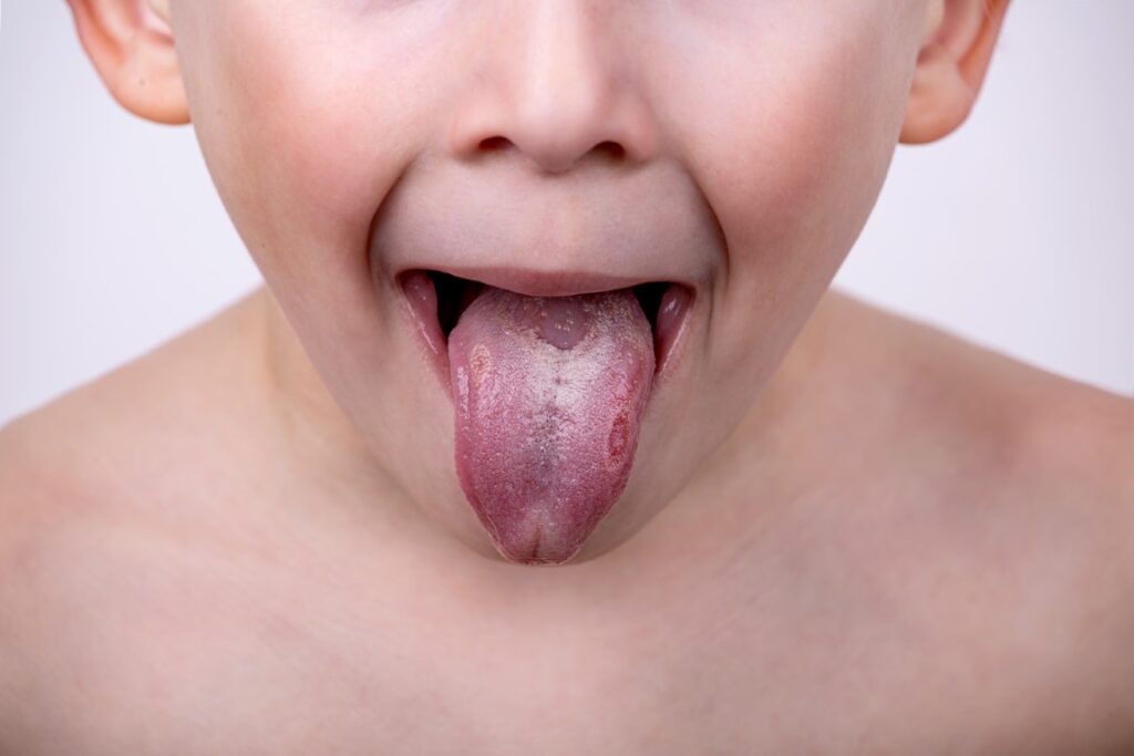Brulures graves sur la langue d'un enfant