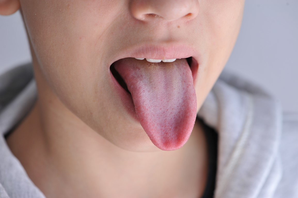 Comment soigner une brûlure sur la langue ? - Santé News