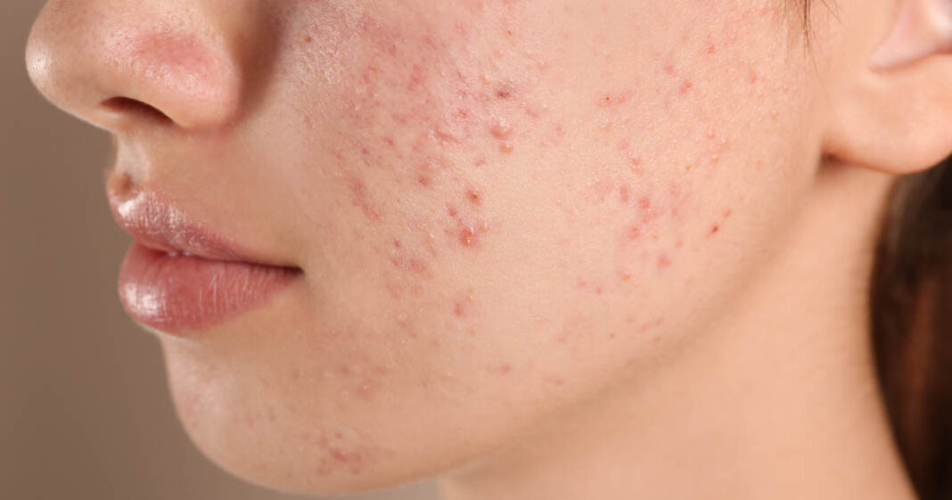 Avoir de l'acné à un moment donné serait en réalité bon pour la peau