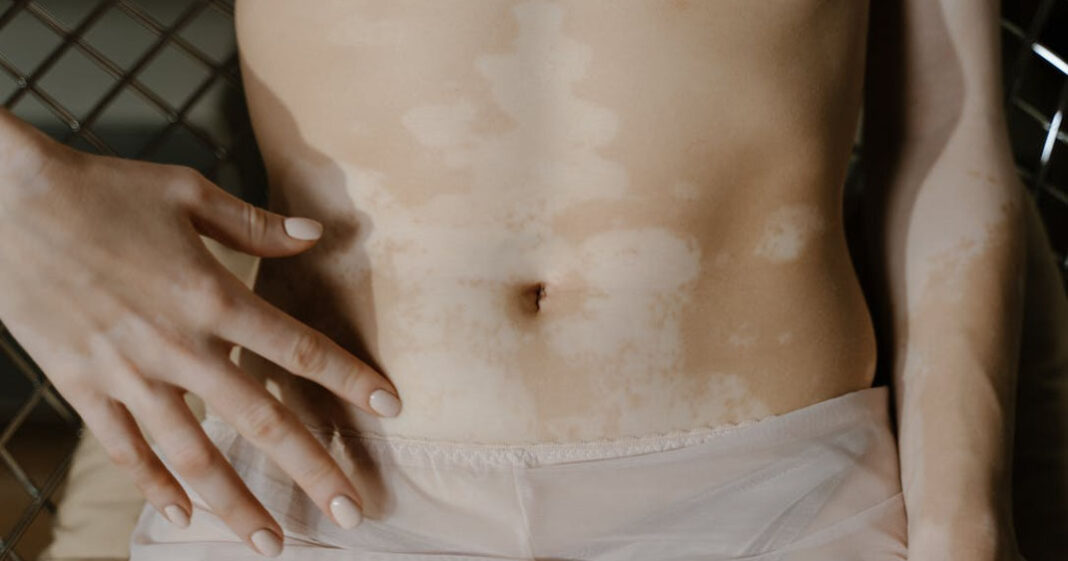 Le vitiligo pourrait se développer au contact des acariens