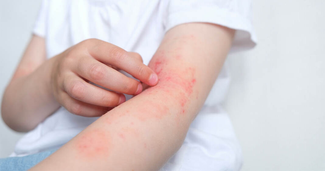Les traitement les plus recommandés pour l'eczéma mis au jour