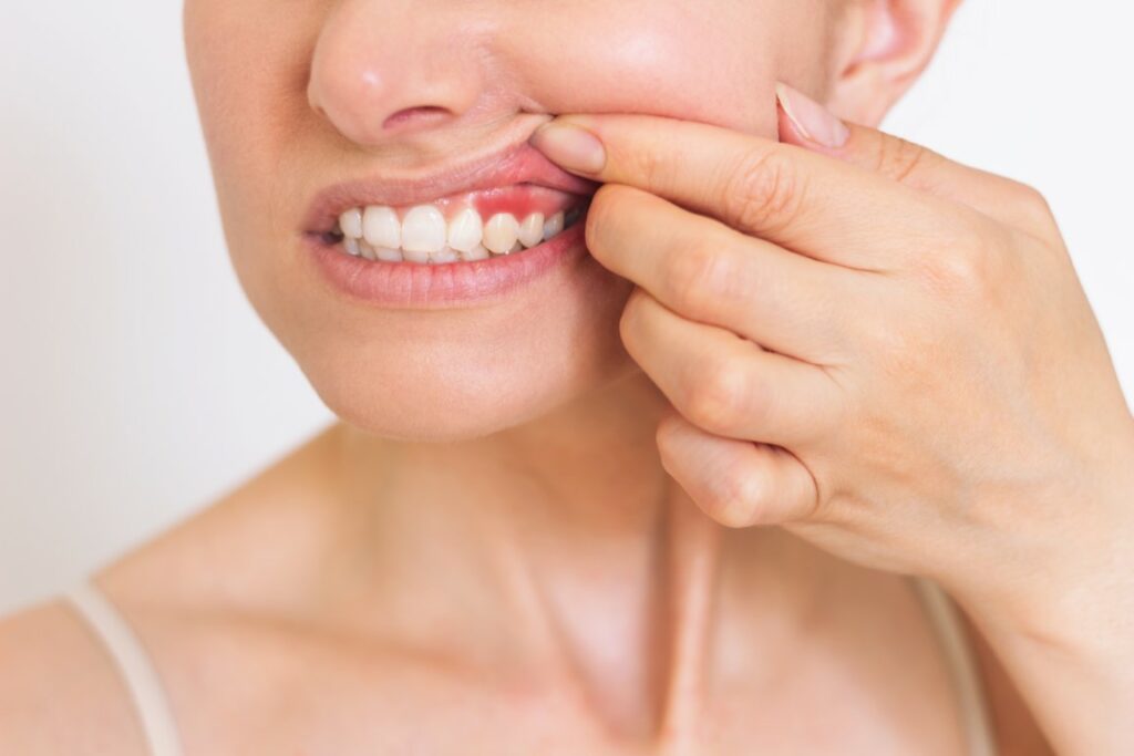 Le mal de dents peut avoir plusieurs origines, y compris au niveau de la gencive