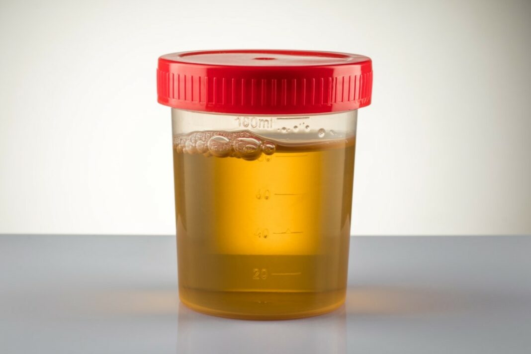 Avoir une urine foncée au réveil