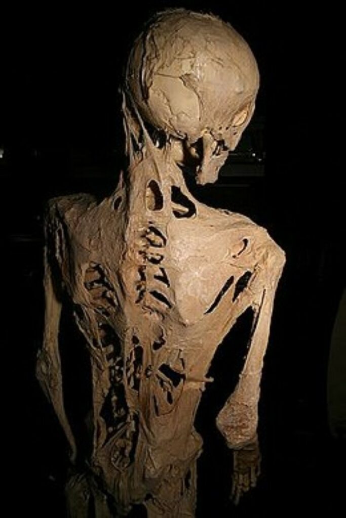 Squelette d'un adulte souffrant de la maladie de la pierre