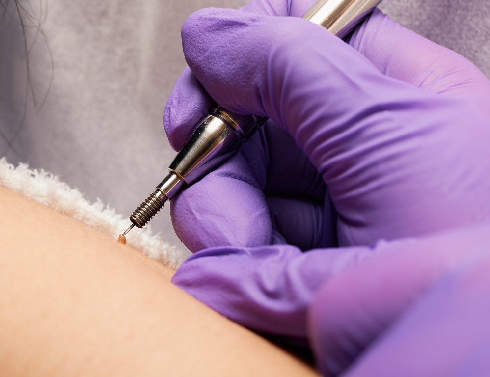 La technique de l'électrocoagulation