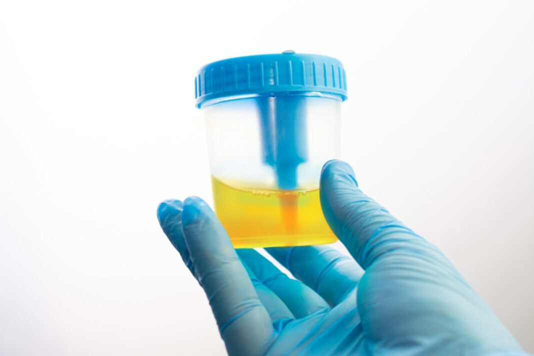 Avoir un échantillon d'urine jaune fluo