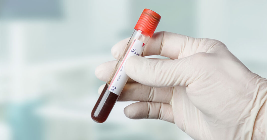 Un nouveau test sanguin très efficace pour la détection du cancer colorectal