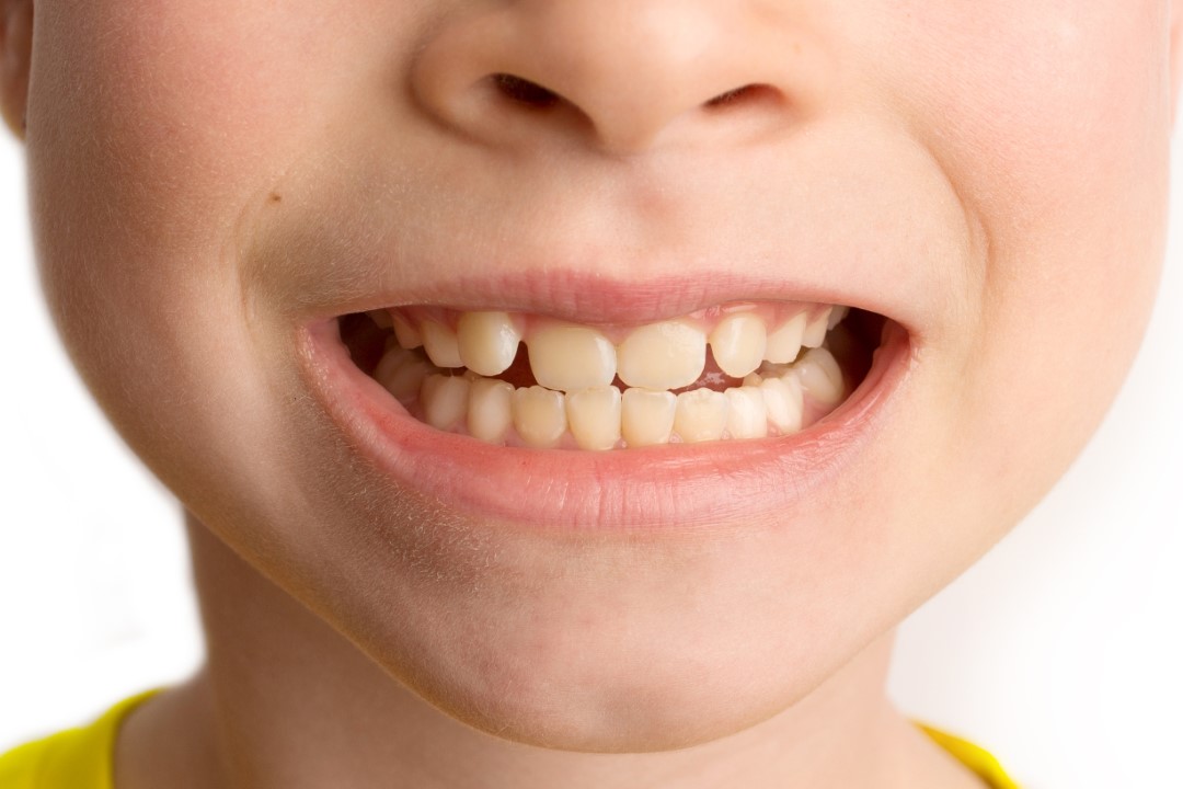 Mon enfant a des soins d’orthodontie : suis-je bien couvert ?